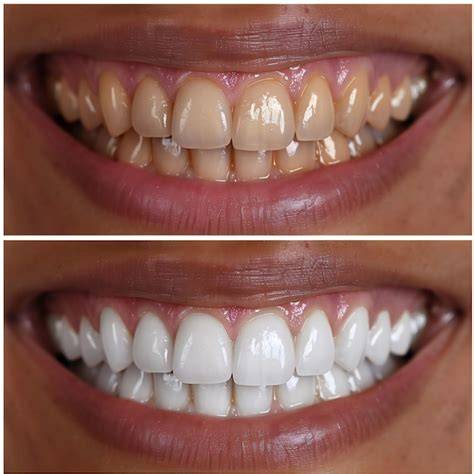 Before and after teeth whitening examples