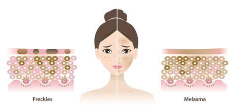 Freckles distribution diagram on face